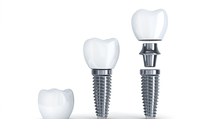 インプラント治療はこんな方におすすめ